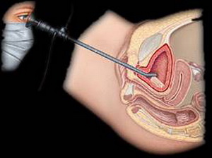 膀胱结石手术的经尿道膀胱碎石取石术治疗,以其创伤小的优点,广泛
