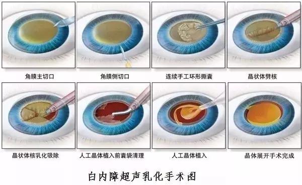 小切口白内障手术图解图片